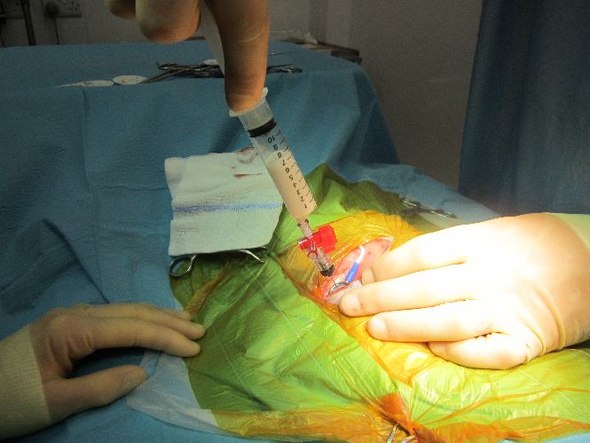 Passing a special Huber needle into the access port